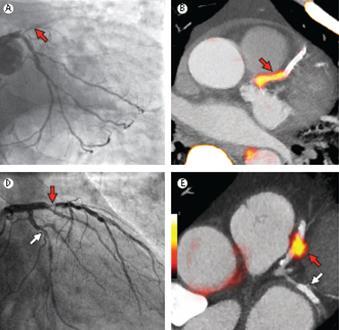 F-18 Sodium Fluoride PET Identifies Ruptured and High-Risk Coronary Plaques 40 AMI 93% uptake in culprit plaque at ICA 40 Stable angina