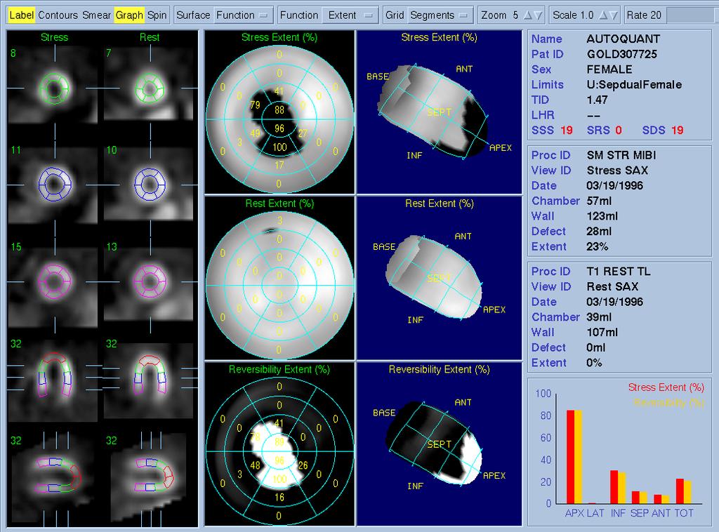 Value-based Cardiac Imaging in CAD Nuclear Cardiology Instrumentation/software Automatic quantitation Increased resolution SPECT: CZT PET: