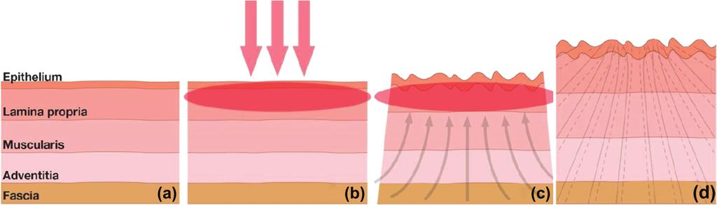 Figure 2 Mechanism of action of non-ablative SMOOTH-mode erbium laser on the vaginal mucosa: (a) the structure of vaginal mucosa consisting of the epithelium, lamina propria, muscularis, adventitia