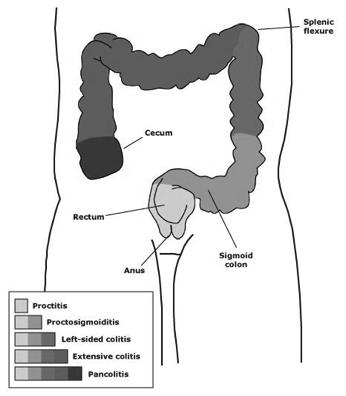 Colectomy for Ulcerative Colitis: What your patient should know Madhulika G.