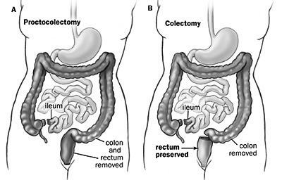 Emergent/Urgent (little time for counseling) Total Abdominal Colectomy