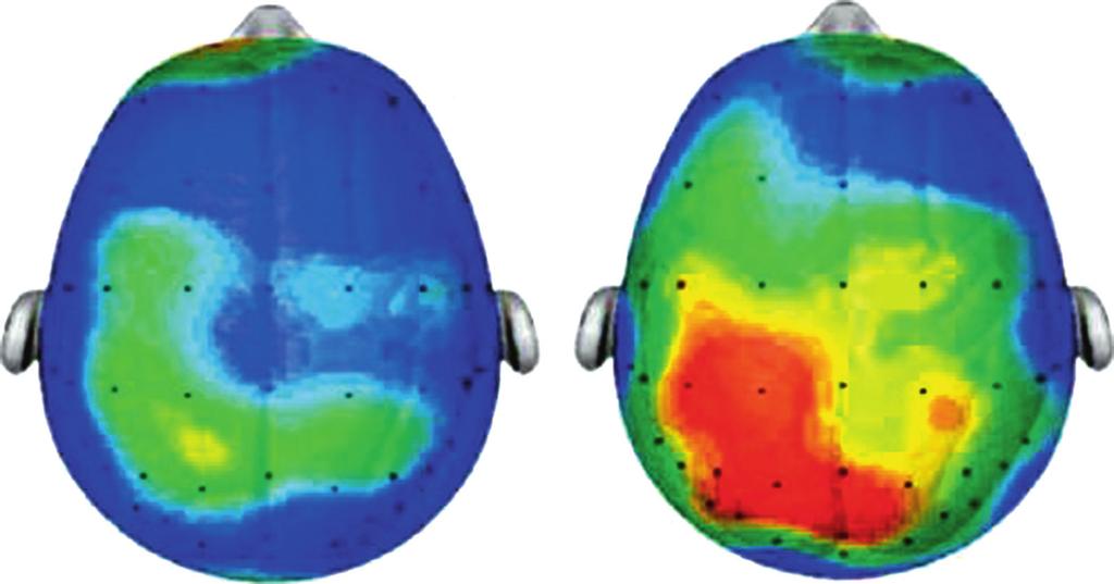 10 2 The Popularity and Benefits of Sport and Exercise: Implications in Dentistry The red section: Increased neuro-electrical brain activity after exercise Fig. 2.3 Brain activity of children before and after exercise: a 20 minute walk (Source: Dr Chuck Hillman, University of Illinois) Fig.