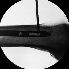 Under image intensification, insert the tip of the 4.0 mm Drill Bit with Coupling for RDL into the incision and place the bit oblique to the X-ray beam until the tip is centred in the locking slot.