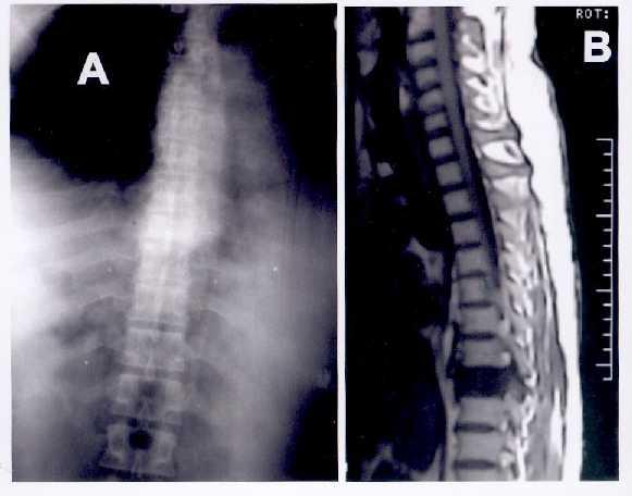 Legends Figure 1: (A) X-Ray dorsal spine showing collapse of Th 8