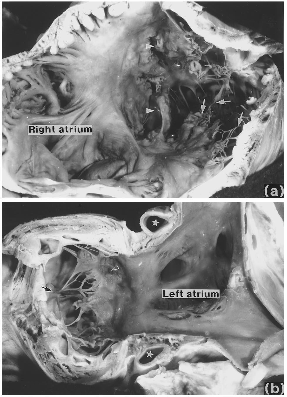 C. Stamm et al. / European Journal of Cardio-thoracic Surgery 12 (1997) 587 592 589 was discovered involving both the tricuspid and mitral valves in one case (Fig. 1b).