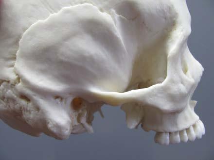 Human Female European Skull Product Number: Specimen Evaluated: Skeletal Inventory: BCM-891-A Bone Clones replica 1 cranium with dentition 1 mandible with dentition Dentition: The skull exhibits full