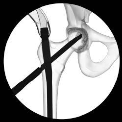 Augmentation Inject radiographic contrast agent into the femoral head and monitor the flow under image intensification. Remove the side-opening cannula.