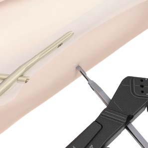 Distal Locking Short Nails (170 mm, 200 mm, and 235 mm) 1. Reconfirm reduction Instrument 03.010.
