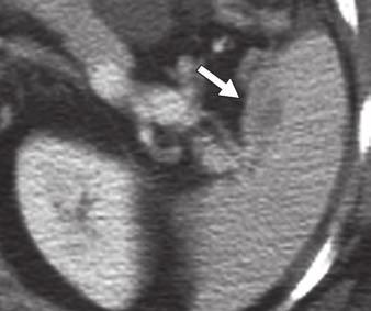 912) was present between patients with residual disease of 1.1 2 cm and patients with residual disease larger than 2 cm on CT.