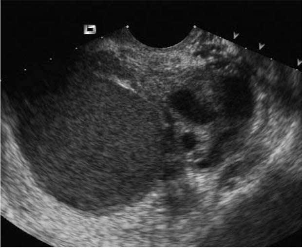 FIGURE 1 Transvaginal ultrasound image of kissing ovaries in the presence of a unilateral endometrioma.