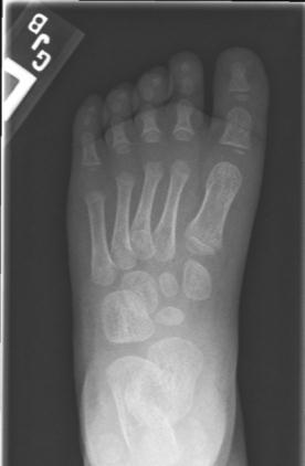 5 mas) AP Left Foot Distal