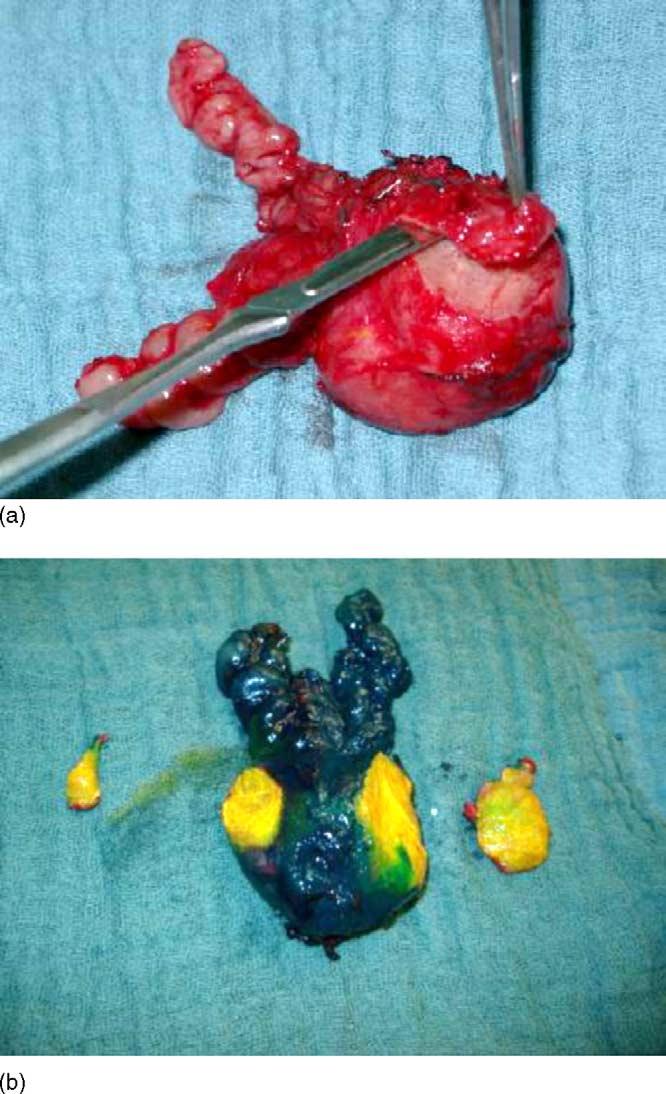 46 european urology 49 (2006) 38 48 Fig. 9 The mucosa of the bladder is everted using a 4 0 Vicryl suture and the bladder outlet is narrowed using a tennis racket technique.