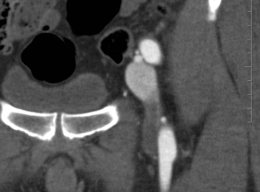 SORRY, THAT S INCORRECT. What salient findings are present on the CT angiogram performed on current presentation? (Click one of the following) A.