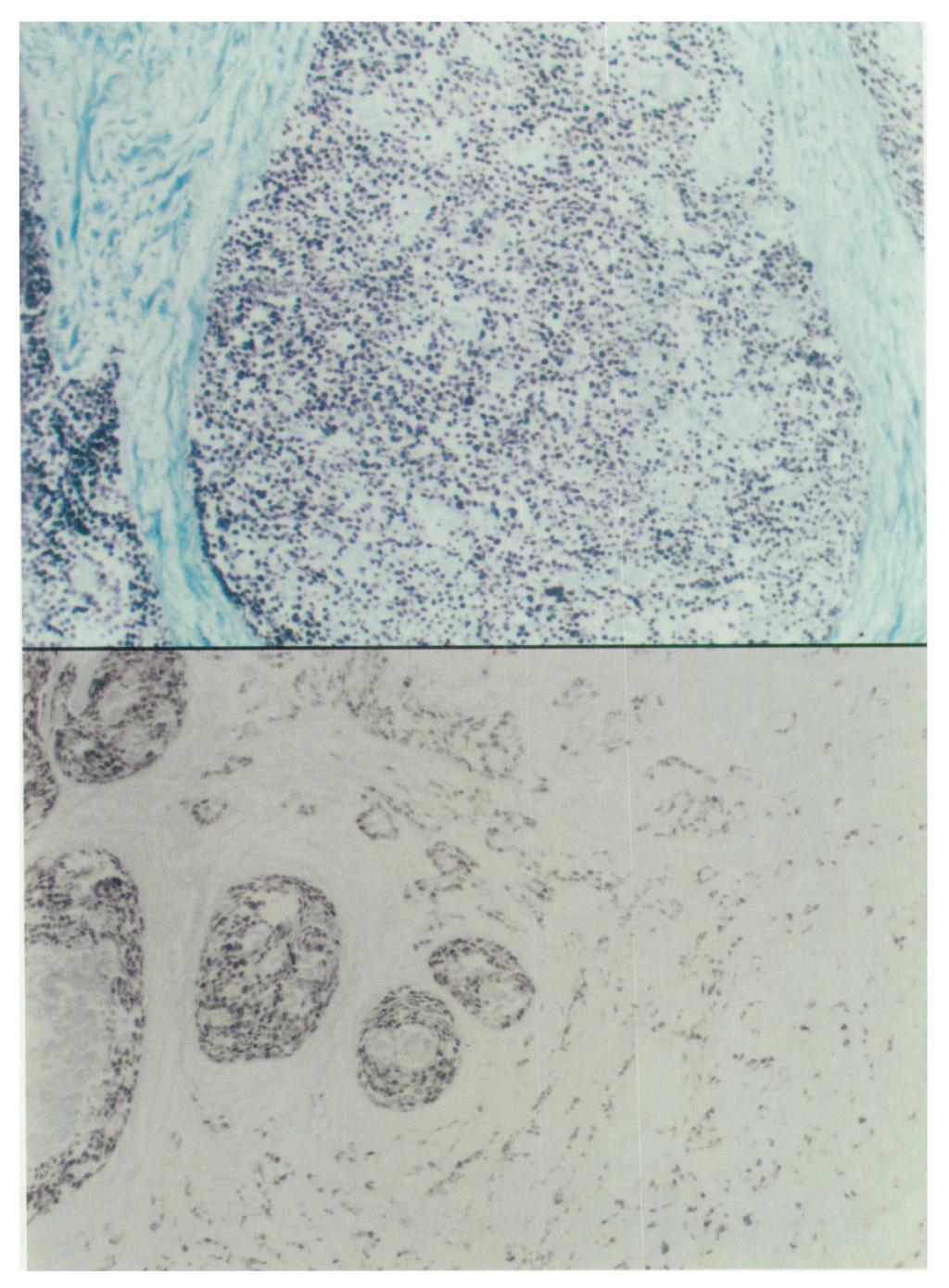 Most invasive carcinomas displayed the same ER staining pattern and level of intensity as the adjacent CIS component. ICA counterstain with methyl green (X100).