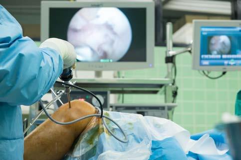 Arthroscopy is a surgical procedure in which the joint is viewed using a small camera.