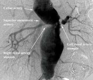 A B Figure 1. Aortogram demonstrating bilateral RAS within the midst of a thoracoabdominal aneurysm. Attempted left renal artery angioplasty was both unsuccessful and ill-conceived. Figure 2.