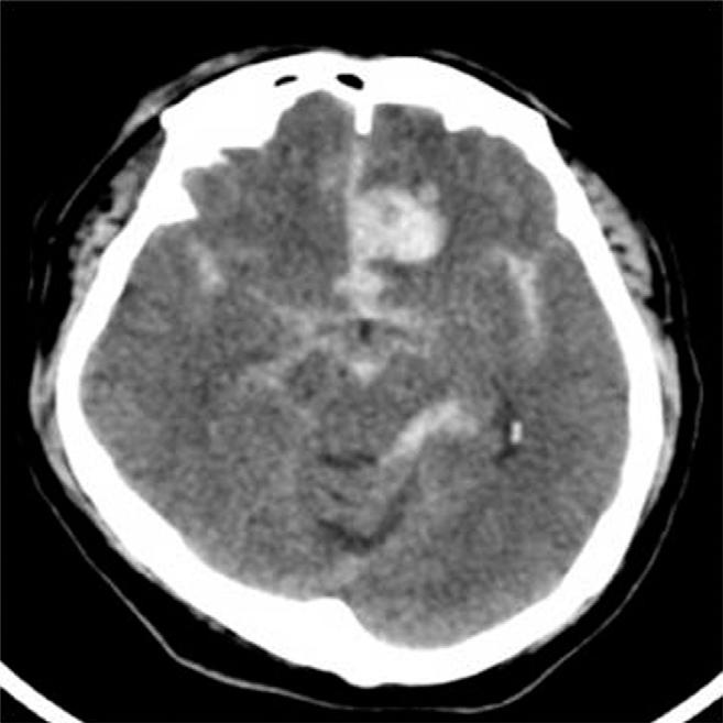 HYO SUB JUN ET AL A B C Fig. 1. Brain computed tomography demonstrated subarachnoid hemorrhage in the basal cistern and a hematoma on the left frontal lobe.