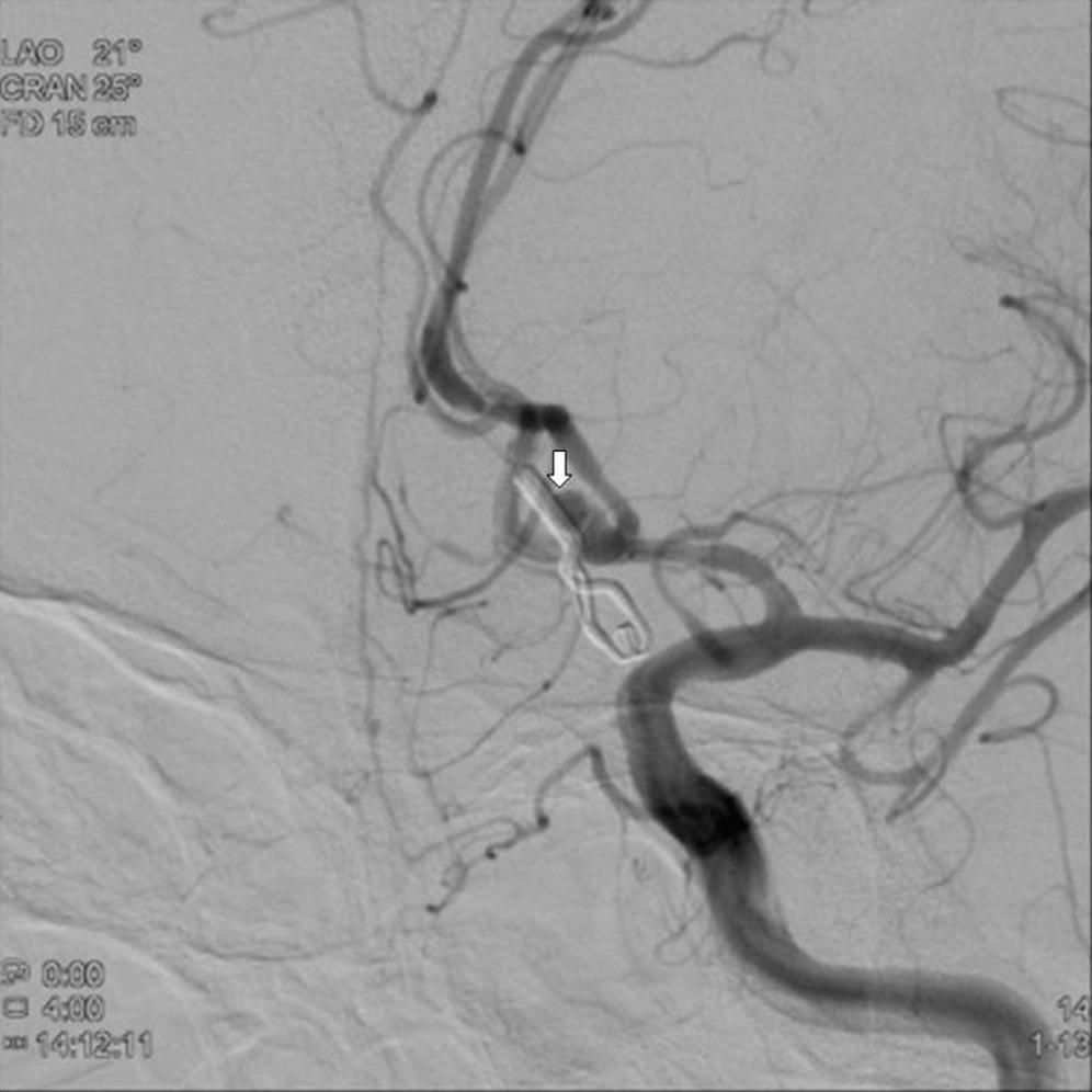 SPONTANEOUS REGRESSION OF ANEURYSM REMNANT A B Fig. 2.