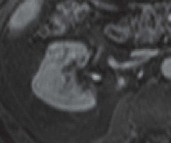 Imaging of the ipsilateral adrenal gland and venous spread of tumors are out of the scope of this chapter, thus the clinical setting of small renal tumors is not found incidentally, as it is the case