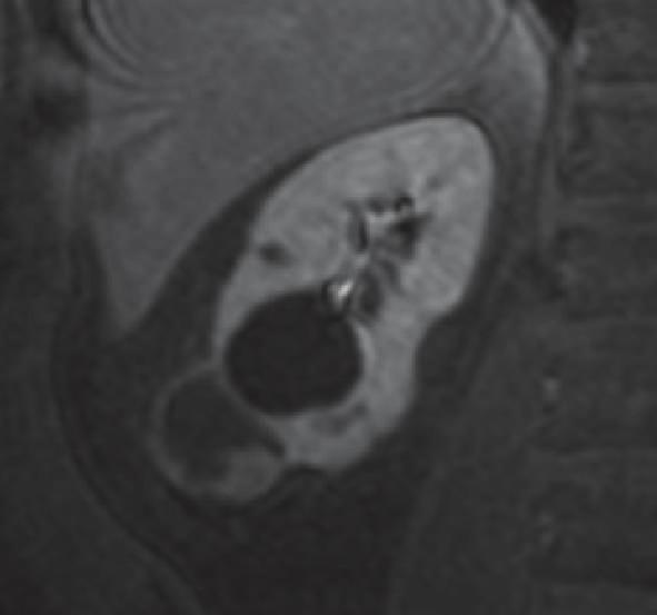 As with all imaging techniques, it is extremely difficult with MR to determine whether malignant tissue extends to adjacent normal tissue when strictly regular margins are found because microscopic
