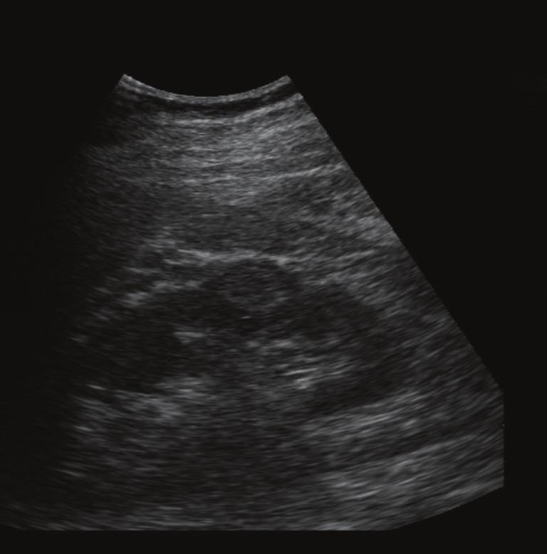 However, one or two thin septations may also be visible sonographically in simple renal cysts [11].