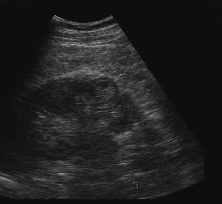 However, other atypical features sonographically detected calcifications; more than two septations, septal thickening or nodularity, and the presence of solid components indicate that sonography