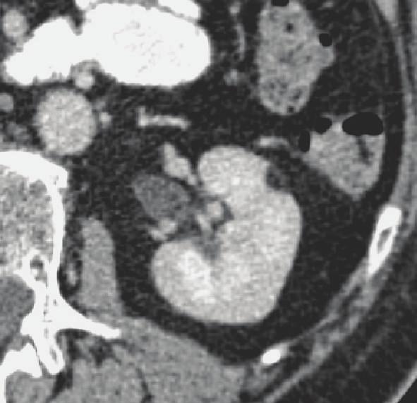 A. Marhuenda et al. 5 Figure 6: Angiomyolipoma. Contrast-enhanced CT shows a small homogeneous fat-containing mass. (a) A A:1.63 cm (b) Figure 7: Oncocytoma.
