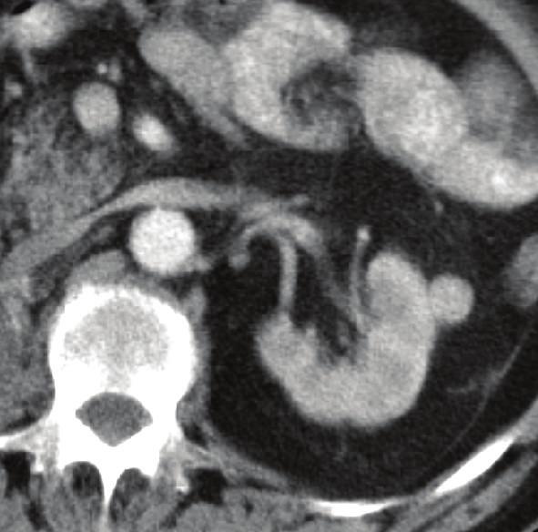 (a) Contrastenhanced CT shows small renal mass that enhances early in corticomedullary phase. (b) Rapid washout in nephrographic phase.