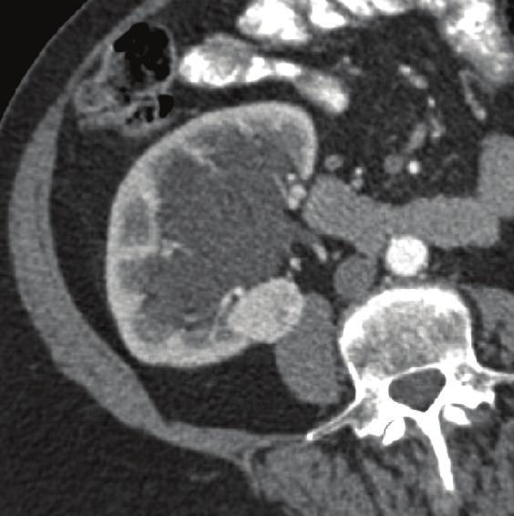 Because of its lack of specificity, patient management has been unaffected by the presence of this finding. Renal cell carcinoma and oncocytoma are indistinguishable from each other at imaging. 4.