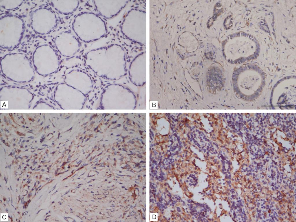 Figure 1. Immunoreactivity in normal gastric glands and gastric carcinoma.