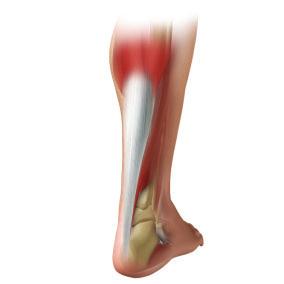 Common treatments for an Achilles Tendinosis Recover technique; Platelet Rich Plasma (PRP) injections Activity restriction Rest Physiotherapy Shoe insert (heel wedge) Recover PRP