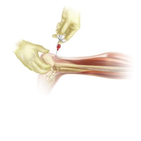 Recover; Natural treatment of your Achilles tendon Recover treatment A 60 ml sample of blood is withdrawn from your arm.