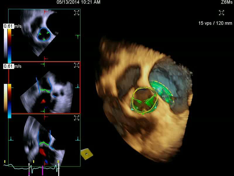 coronary ostia can be easily measured within a 3D-TEE data set.