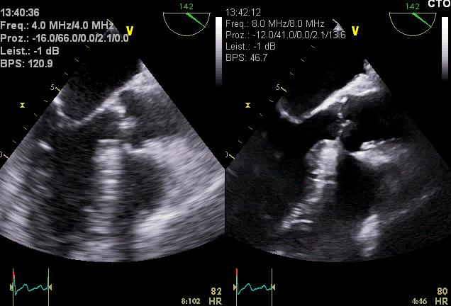Prerquisite for excellent image quality in 2D as well as 3D echocardiography: knowledge about ultrasound physics and implementation of these aspects into