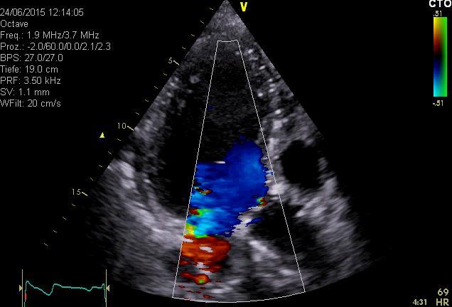 pre 3D- and Multidimensional Echocardiography pre post Comparison pre- and post-aortiv valve repair surgery