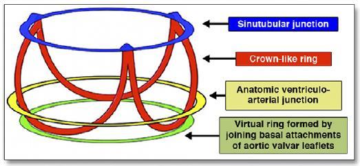 Sinutubular junction Anatomical