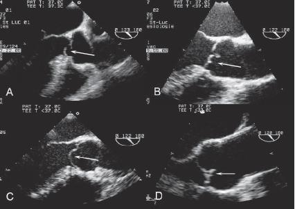 This figure (2007) does not represent the actual standard of echocardiography in the