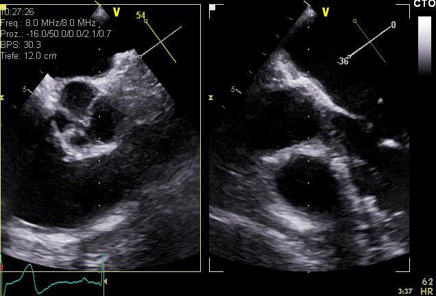 The orientation of imaging in TTE and TEE It is obvious but sometimes not present.
