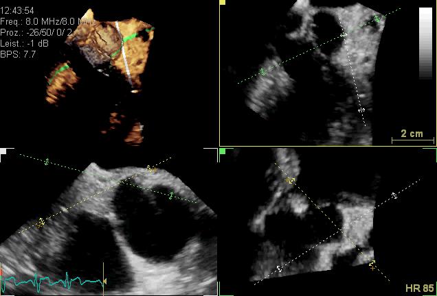 The documentation of special cardiac structures: Anatomy of coronary ostia and