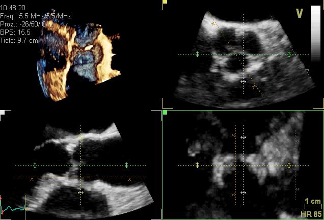 short axis view aortic valve 3D4Ddata-set: