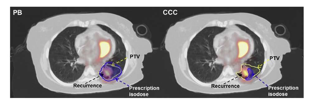 Outcome monitoring Latifi et al Study of 201 non-small cell lung cancer patients given stereotactic ablative radiation therapy shows