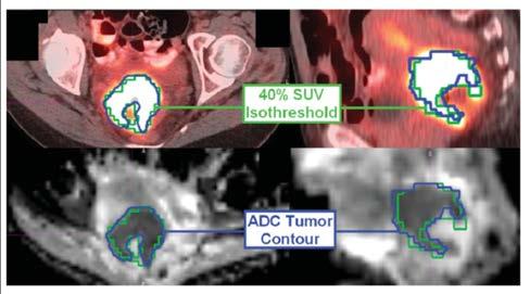 Quantitative Imaging Tumor volume delineation in RO implies boarders PET-CT