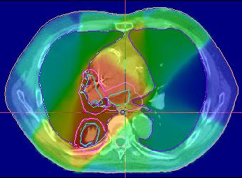 Optimization of radiotherapy planning of patients