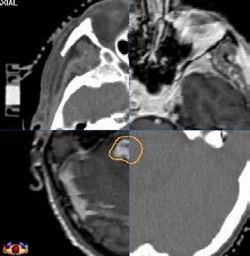 MRI mainly for brain lesions Image