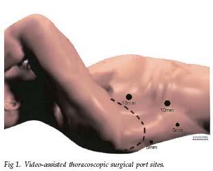 Minimally Invasive Esophagectomy (Ivor-Lewis) 3,4,5 First described by Depaula in 1995 Combined