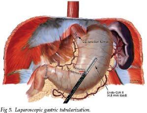Laparoscopic portion 3,4,5 Supine, port placement as for laparoscopic Nissen Divide gastrohepatic ligament,