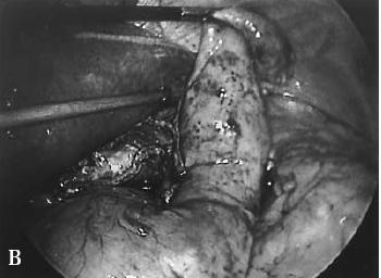 esophagus, deliver specimen Laparascopically place gastric tube into the