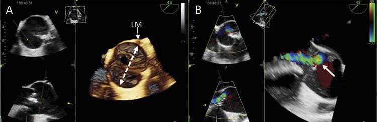 On the apical 3-chamber view, a turbulent systolic flow through the aortic valve was observed (panel B, arrow) and the continuous wave Doppler showed a dense spectral signal with a peak velocity of 4.