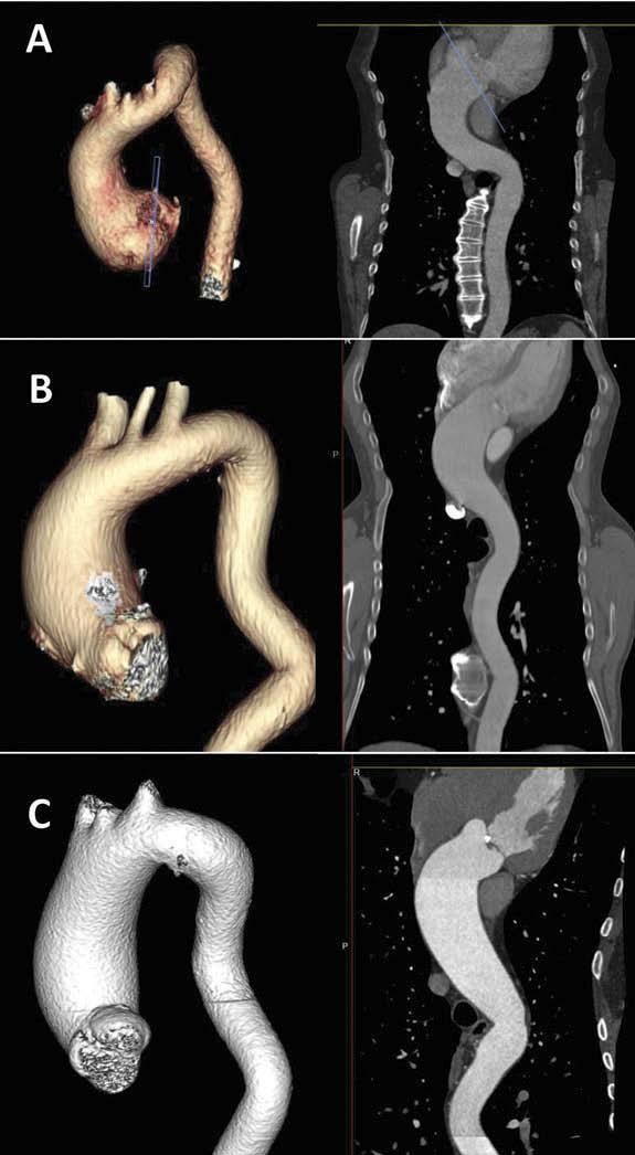 12 A. C. T. NG ET AL.: BAV INSIGHTS STRUCTURAL HEART Figure 5. Type of aortic root and ascending aorta dilatation in BAV patients.