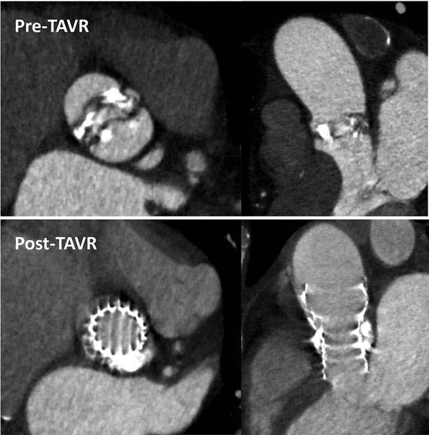 A. C. T. NG ET AL.: BAV INSIGHTS STRUCTURAL HEART 15 Figure 7. Transcatheter aortic valve replacement in bicuspid aortic valve.